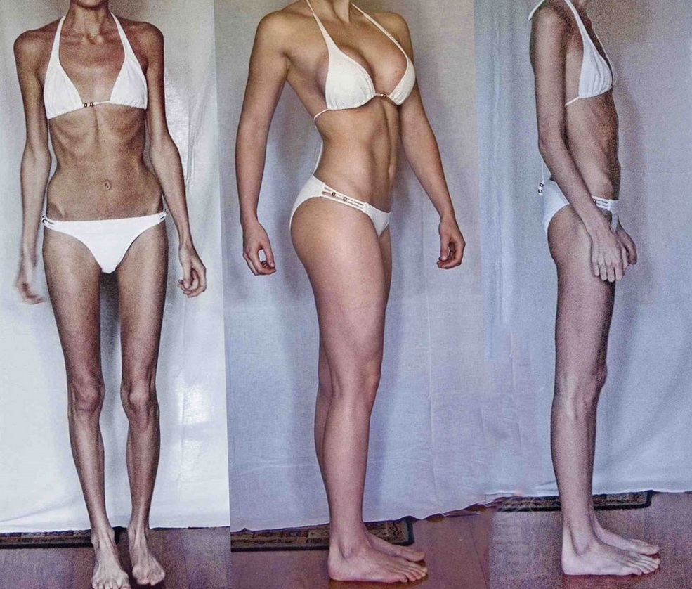 Anoreksiya 10
