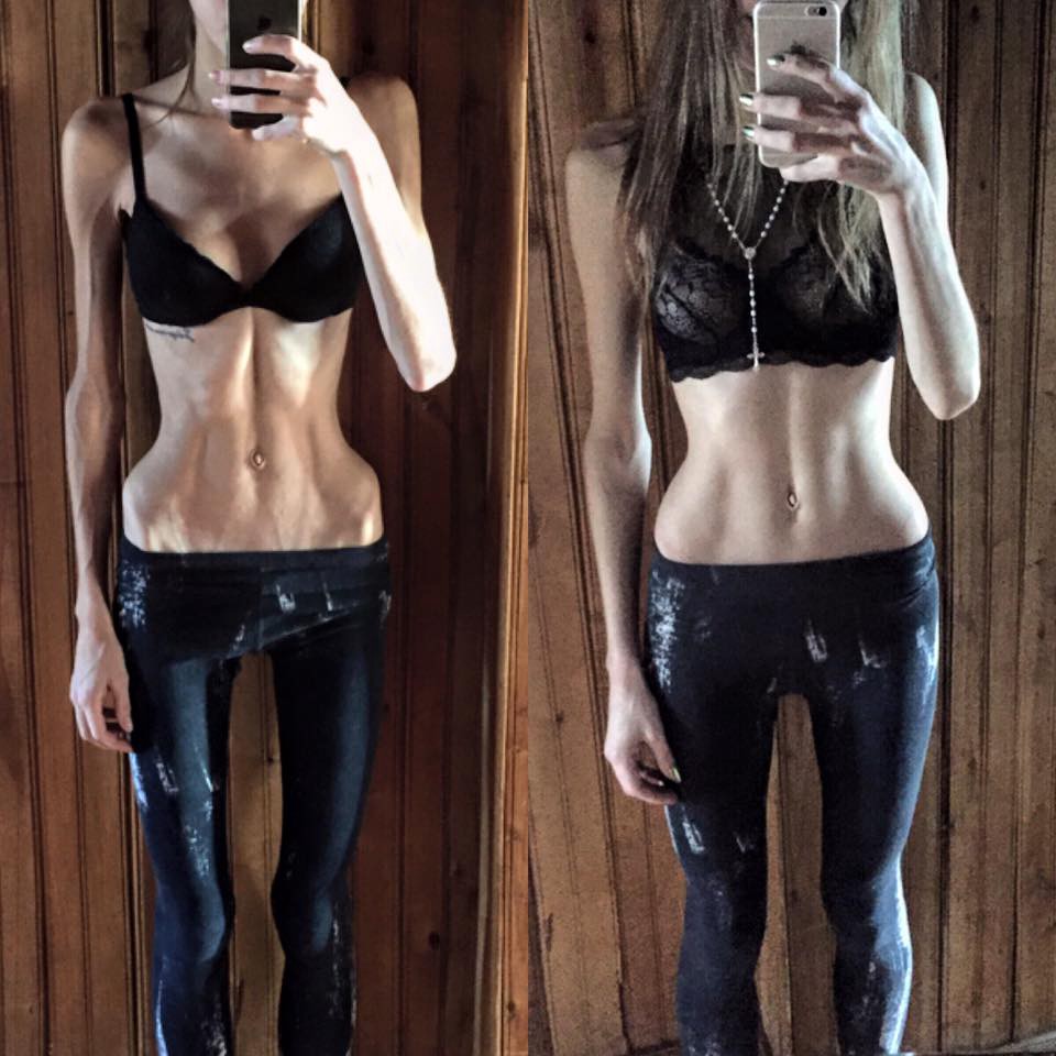 Anoreksiya 2